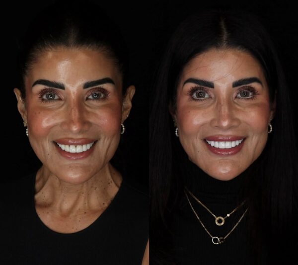 20 Laminate Veneers