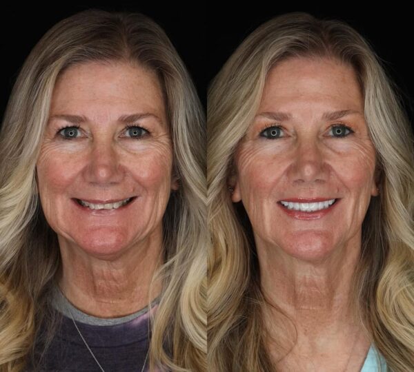 All on Six Dental Implants in Istanbul