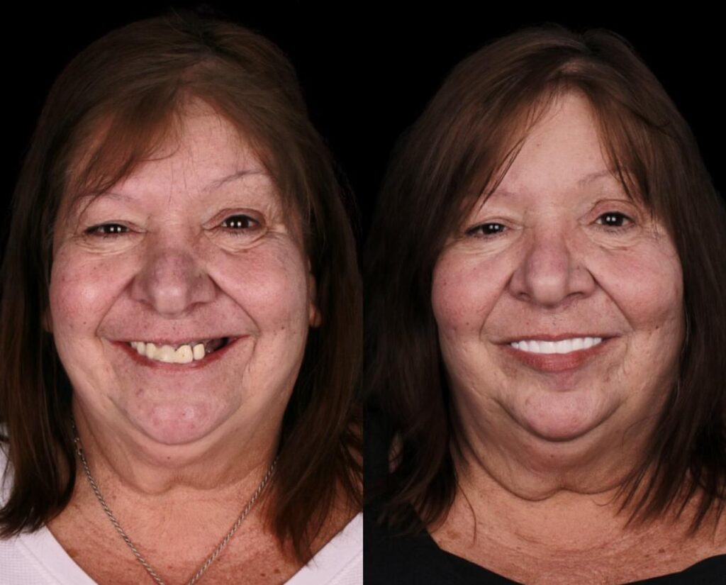 Dental Implants and Monolithic Zirconium Crowns