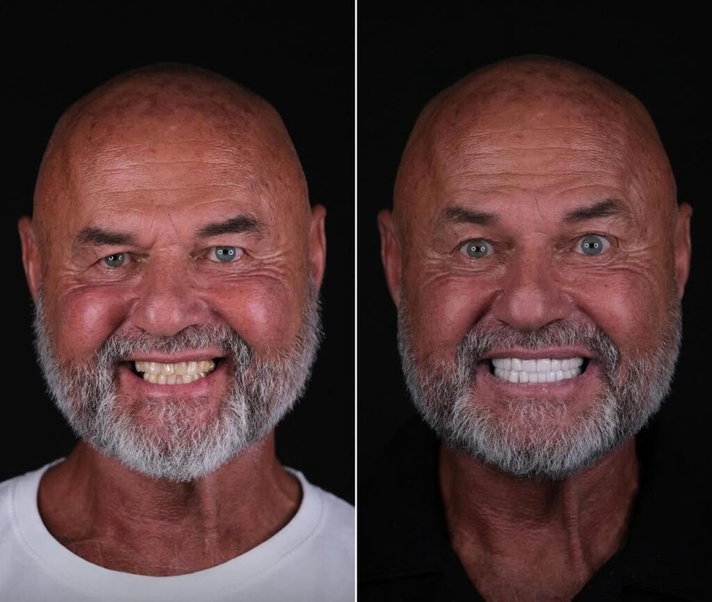 Getting 6 Implants in Istanbul