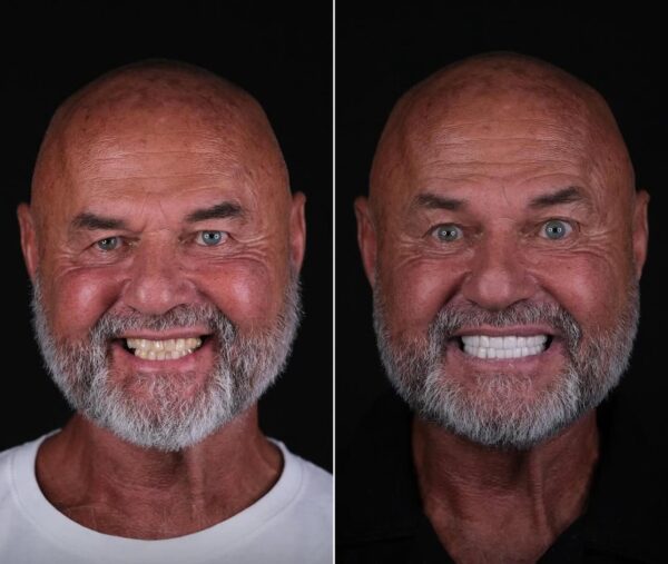 Getting 6 Implants in Istanbul