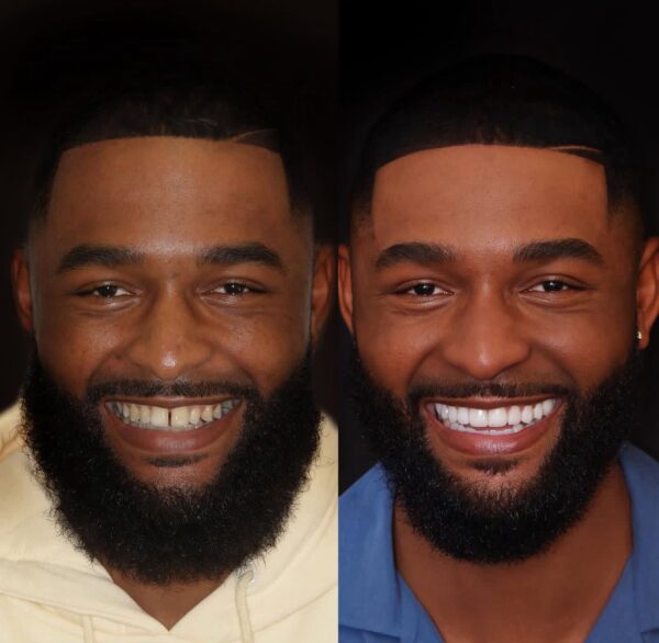 Full Smile Makeover in Istanbul