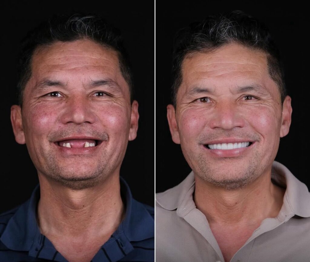 All on Six Dental Implants in Istanbul